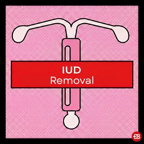 Iud removal edb